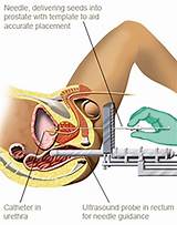 Prostate Cancer Procedures Treatment Pictures