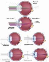Does Lasik Eye Surgery Work For Astigmatism Photos