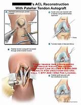 Acl Hamstring Graft Recovery Pictures