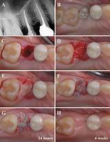 Bone Graft Recovery Images