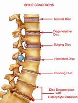 Pictures of Chiropractic Treatment For Herniated Disc In Lower Back
