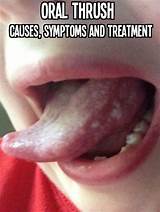 Photos of Thrush Mouth Treatment Adults