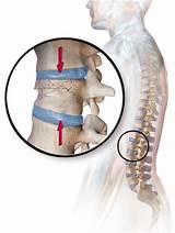 Images of Fractured Vertebrae Surgery Recovery Time