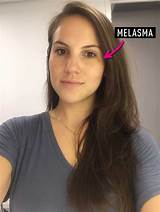 Melasma Makeup Foundation Images