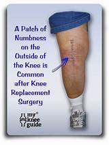 Recovery From Knee Replacement Surgery Elderly