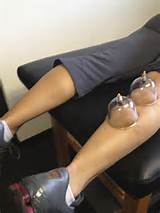 Pictures of Cupping Therapy