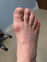 Great Toe Arthritis Treatment Photos