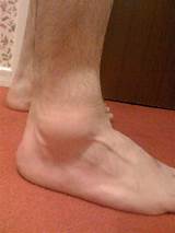 Images of Sprained Ankle Recovery Time Grade 3