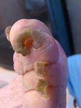 Severe Foot Fungus Treatment Photos