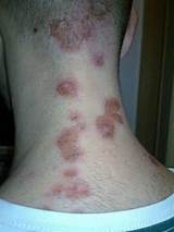 Pictures of Bed Bug Treatment Cost