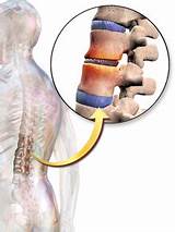 Pictures of Can Ankylosing Spondylitis Cause Weight Loss