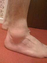 Swollen Ankle Sprain Treatment Pictures