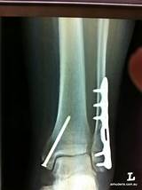 Pictures of Screw Removal Surgery Recovery Time