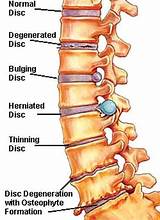 Therapy For Degenerative Disc Disease Photos