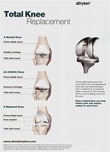 Images of What Is The Recovery Time From Knee Replacement Surgery