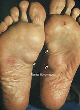 Treatment For Plantar Fascial Fibromatosis Images