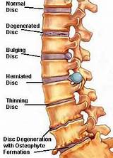 What Is Djd In Medical Terms Images