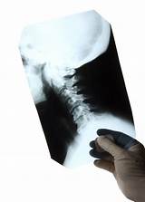 Work Related Back Injury Settlements