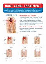 Price Of Root Canal Pictures