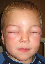 Pictures of Allergic Reaction To Shrimp Treatment
