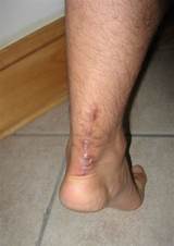 Recovery After Achilles Tendon Surgery Images