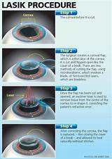 Pros And Cons Of Lasik Eye Surgery 2012 Photos