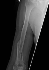 Images of Femur Fracture Recovery Time