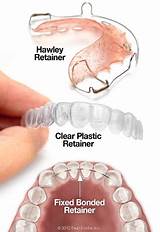 Images of Picture Of Orthodontic Retainer