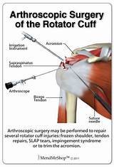 Photos of Post Rotator Cuff Surgery Recovery