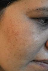 Laser Treatment To Remove Brown Spots