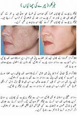 Images of Home Remedies For Freckles On Face In Urdu