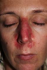 Mohs Surgery On Nose Recovery Time Images