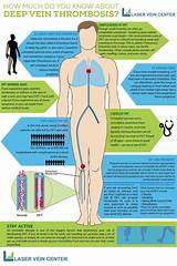 Images of How Much Is Vein Treatment