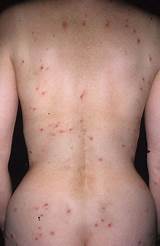 Eczema On Back Treatment Pictures