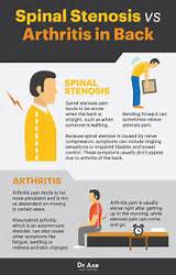 Exercises Spinal Stenosis Images
