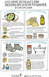 Winter Itch Home Remedies