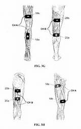 Images of Estim For Muscle Strengthening