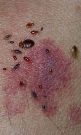 Images of Does Heat Kill Scabies