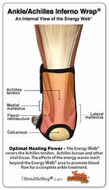 Insertional Achilles Tendonitis Surgery Recovery Time Images