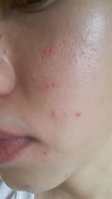 Treatments For Ice Pick Acne Scars Images
