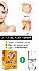 Home Remedies Cystic Acne Images