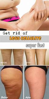 What Is The Best Treatment To Get Rid Of Cellulite Pictures