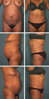 Pictures of Recovery After Tummy Tuck And Lipo