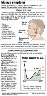 Photos of What Is The Treatment For Mumps Disease