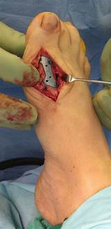 Recovery After Finger Fusion Surgery