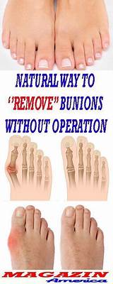 How Do Doctors Remove Bunions