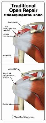 Physical Therapy For Rotator Cuff Surgery Recovery Photos
