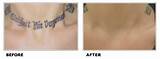 Laser Tattoo Removal Pictures After Each Treatment Photos