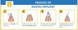 Permanent Dental Implants Procedure Photos