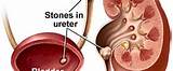 Images of Kidney Stone Removal Recovery